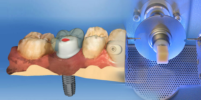 Cerec Cad Cam-System