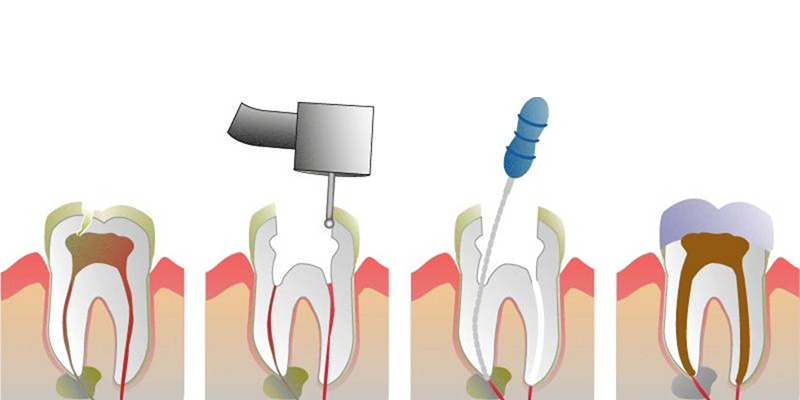 Endodonti (Kanal Tedavisi)