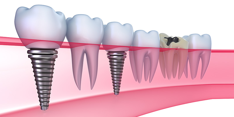 Dental Implants