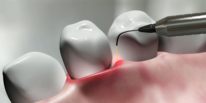 Laser Dentistry