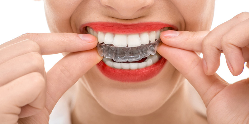 Orthodontics with Transparent Plates (wireless)
